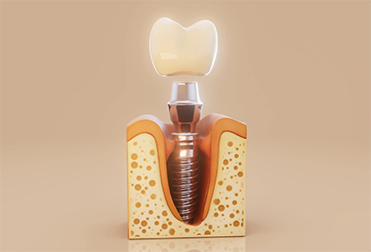 Implants dentaires Tunisie