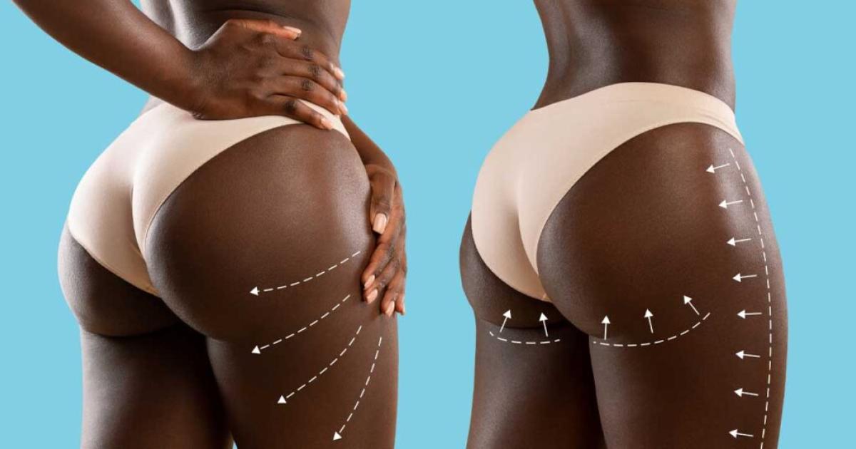 Chirurgie esthétique en Afrique francophone